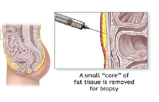 Biopsies Fat biopsy negative for