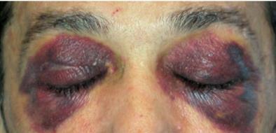 bruising periorbital purpura Macroglossia Neurologic
