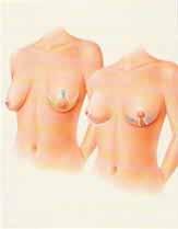 The incision patterns for contouring a woman s sagging breasts will be determined based on the amount of excess skin to be removed.