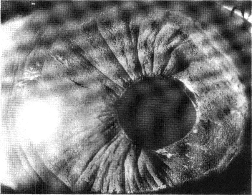 9%) Females 116 3 (2-6%) 230 3 (1-3%) *Excluding those with phthisis bulbi and those with iris atrophy probably associated with anterior segment ischaemia or trauma.