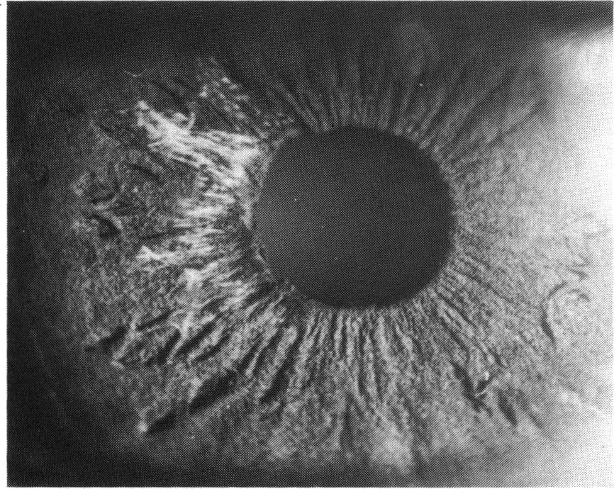 > Fluorescein angiogram of iris in the left eve o -ahyyear-okl male withi SCdiseases. White arrows mark extent of sectoral iris atrop)hiy.