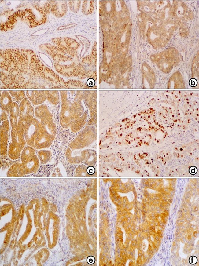 Tumor Biol. (2013) 34:4007 4016 4013 Fig. 2 a f Immunohistochemical detection of ERα, ERβ, aromatase, Ki-67, and COX2 in the human endometrial cancer.