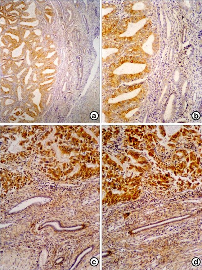 4014 Tumor Biol. (2013) 34:4007 4016 Fig. 3 a d. Expression of COX2 and aromatase in endometrial cancer and adjacent normal endometrium.
