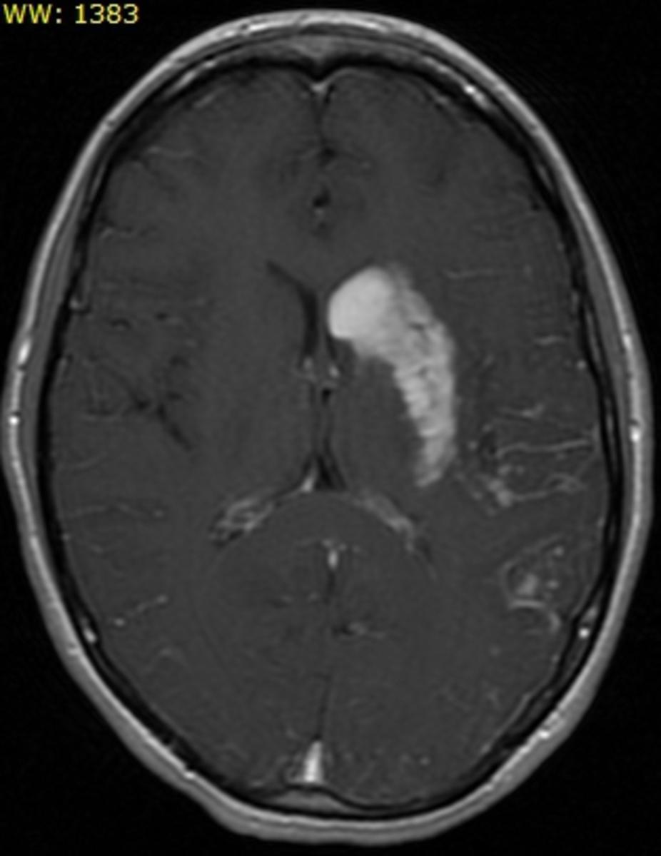 Fig. 7: Axial T1WI with contrast :Luxury
