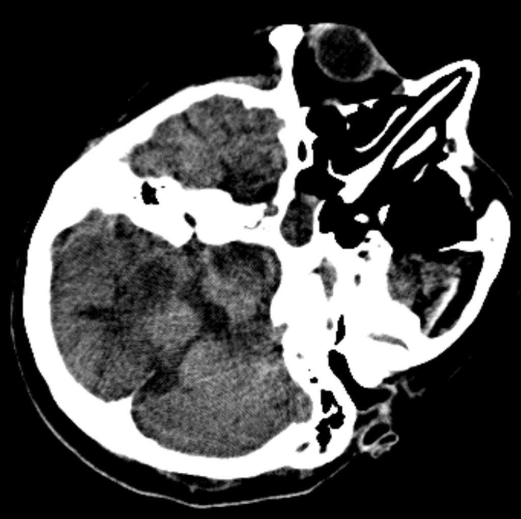 Fig. 12: Gliosis of left cerebellar lobe