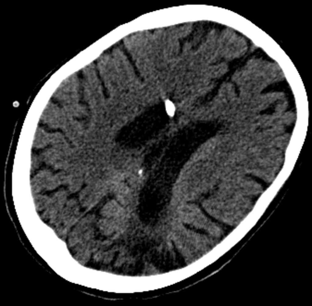 Fig. 13: Old ischemic lesion left