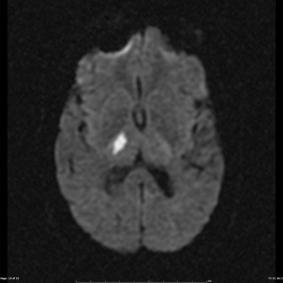 Optic tracts and lateral geniculate nucleus of the thalamus Noted involving