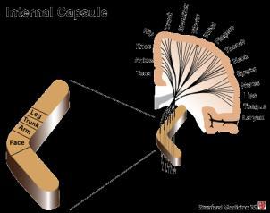 internal capsule stroke or a large ACA + MCA cortical stroke Looking at the