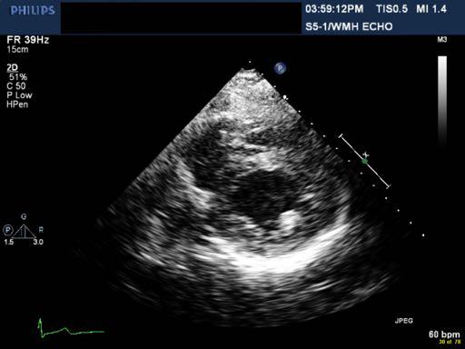 Follow up echo in 2 weeks showed improved EF of 60% and normal wall motion.