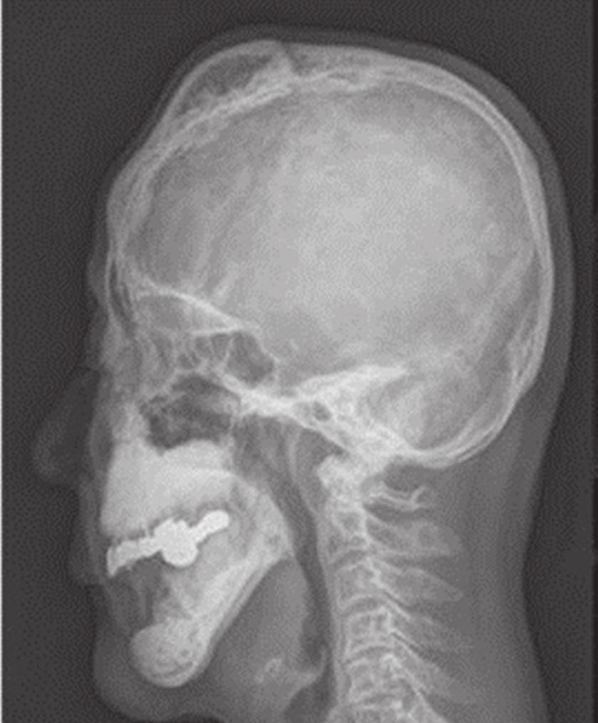 involved vertebrae were identified in the CT and magnetic resonance imaging.