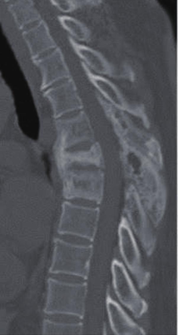 (B) Increased bone formation and bone resorption activity is shown in three lumbar vertebrae with degeneration of
