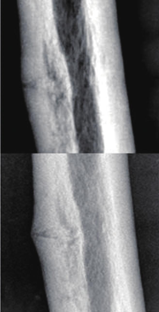 (D) Prophylactic femoral nailing was performed using a new technique which was developed for nailing in atypical femoral fracture associated femoral bowing. femur.