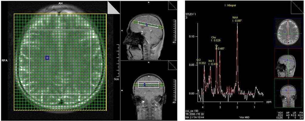 Diagnosis: magnetic resonance spectroscopic imaging (MRSI) Obtain metabolite maps in a noninvasive way