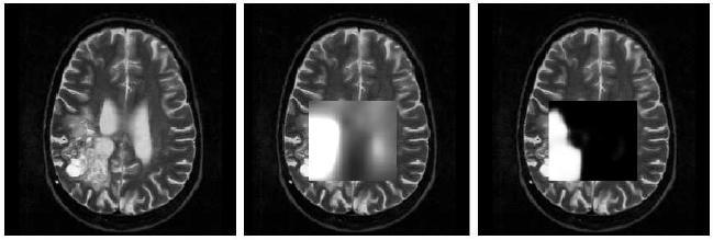 Nosologic imaging: abnormal tissue prior Include prior knowledge from MRSI into the segmentation