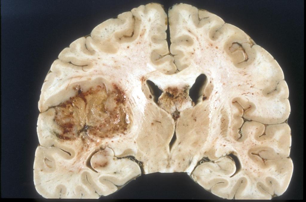 Brain tumors:
