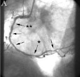RIGHT CORONARY ARTERY OF A 66-YEAR-OLD MAN WITH RECURRENT ANGINA WHO HAD STENT IMPLANTATION IN THE MID-RIGHT CORONARY ARTERY 1 YEAR PREVIOUSLY AND NOW HAS A POSITIVE