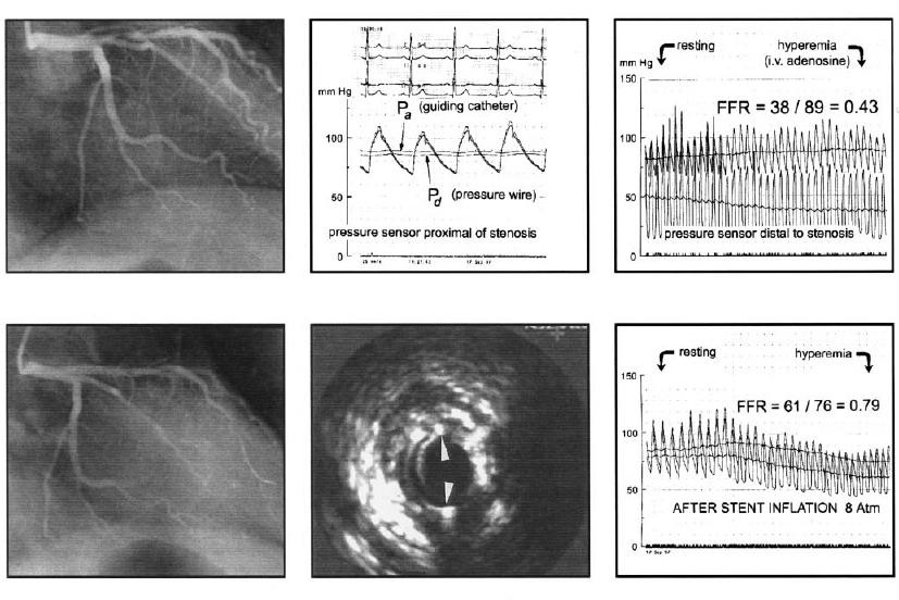 CORONARY ANGIOGRAMS, SIMULTANEOUSLY OBTAINED AORTIC (P A ) AND DISTAL CORONARY (P D ) PRESSURES, AND IVUS IMAGES Angiogram and pressure tracings before