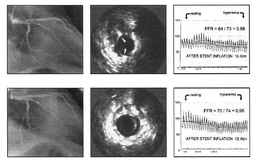 CORONARY ANGIOGRAMS, SIMULTANEOUSLY OBTAINED AORTIC (P A ) AND DISTAL CORONARY (P D ) PRESSURES, AND IVUS IMAGES DURING SUCCESSIVE STEPS OF PROTOCOL IN 49-YEAR-OLD MAN Coronary angiogram, IVUS