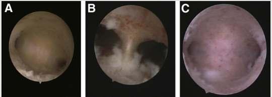 Agreement on the diagnosis of septate uterus From Smit et al.