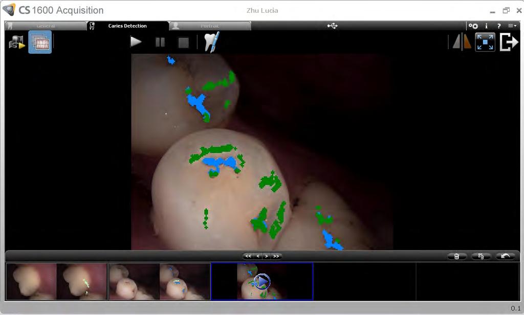 Powerful technology with a simple workflow Caries identification during screening The camera s unique scan and detect workflow promotes faster examinations by identifying exact areas of concern