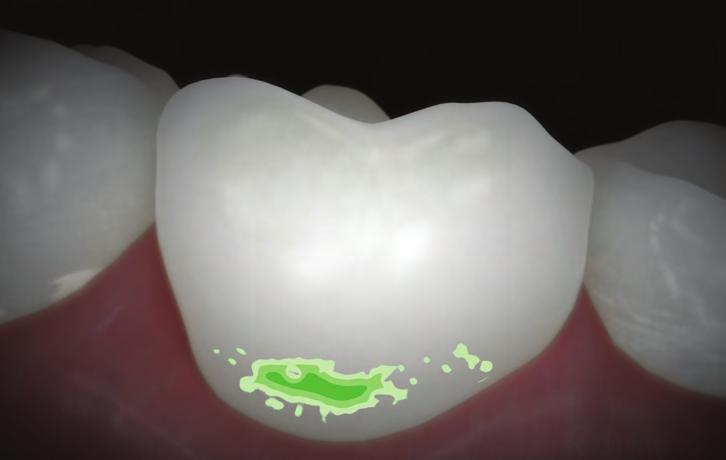 Due to increased light scattering, tooth areas with early caries exhibit stronger diffuse reflectance than sound tooth structures which in turn causes incipient caries to have a white spot appearance.