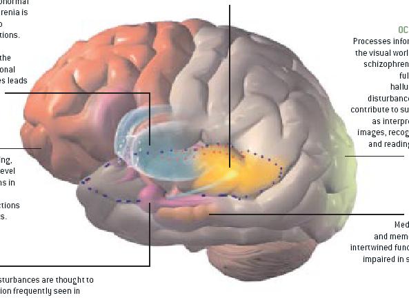 Neuroanatomy of CIAS Basal ganglia: Impaired GABA release, dopamine regulation Auditory cortex: Impaired tone matching, echoic memory Parietal cortex: Impaired attentional allocation, P300 generation
