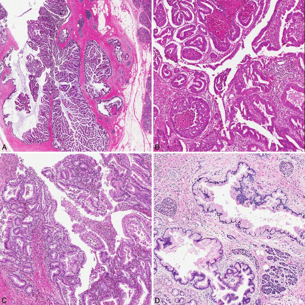 Figure 1. Pancreatic intraepithelial neoplasia. A, Mass-forming tumoral intraepithelial neoplasm of intraductal papillary-mucinous neoplasm in the main pancreatic duct.