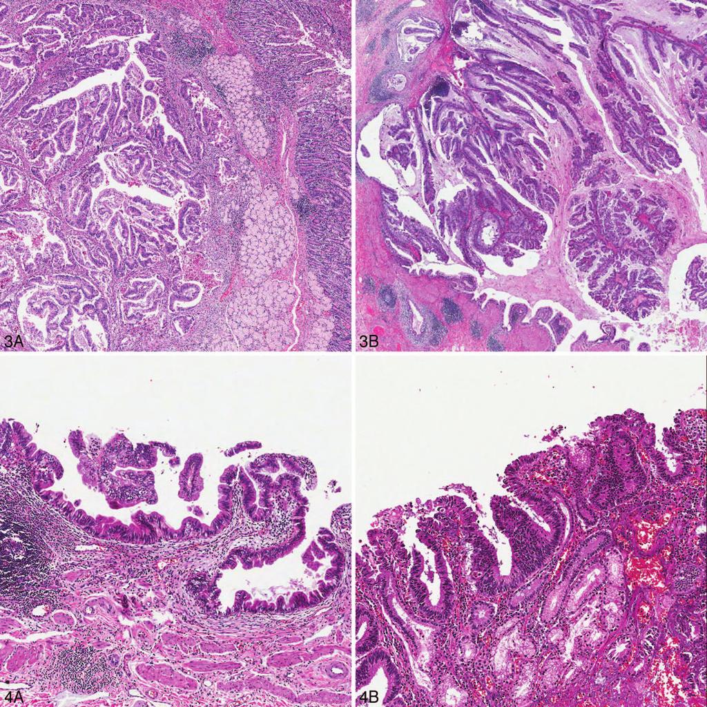 Figure 3. Mass-forming tumoral intraepithelial neoplasia. A, Intra-ampullary papillary-tubular neoplasm of the ampulla of Vater.