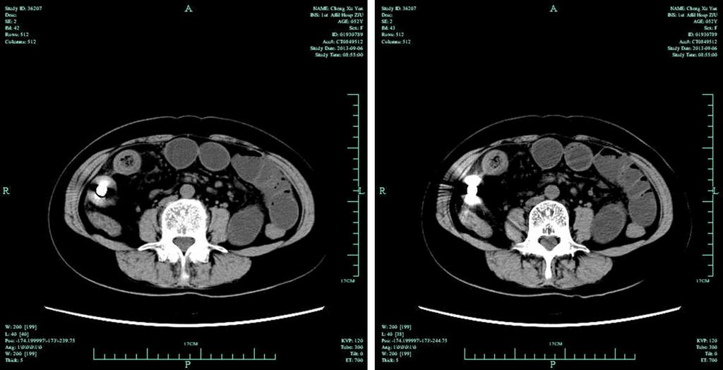 Figure 1. CE retention in CT. Figure 2. The surgery of CE retention. examination.