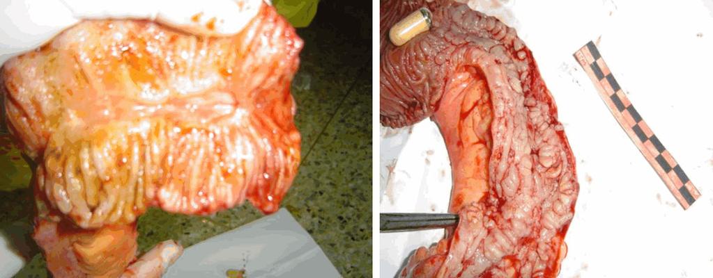 Additionally, deep ulcer prolongs the passage time of capsule endoscopy through intestine.