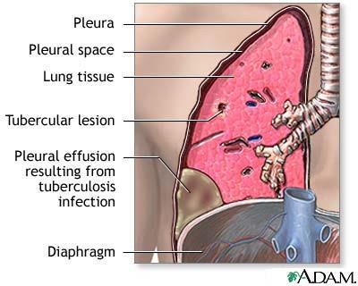 Pleural effusion The pleural cavity contains normally 5-10 ml of serous fluid that is secreted and absorbed normally by the pleura.
