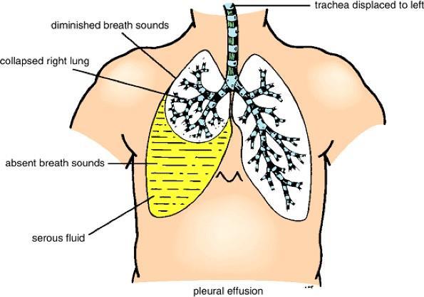 2- Decreased lung sound: a stethoscope is placed on the lobes of the lungs and the patient is asked to breath in and out, the sounds heard will be decreased and abnormal.