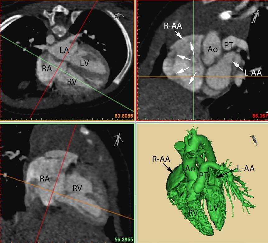 3 Yim et al Disharmonious Patterns of Heterotaxy and Isomerism Figure 1. Multiplanar reformat and 3-dimensional volume-rendered images of a case of situs solitus with tetralogy of Fallot.