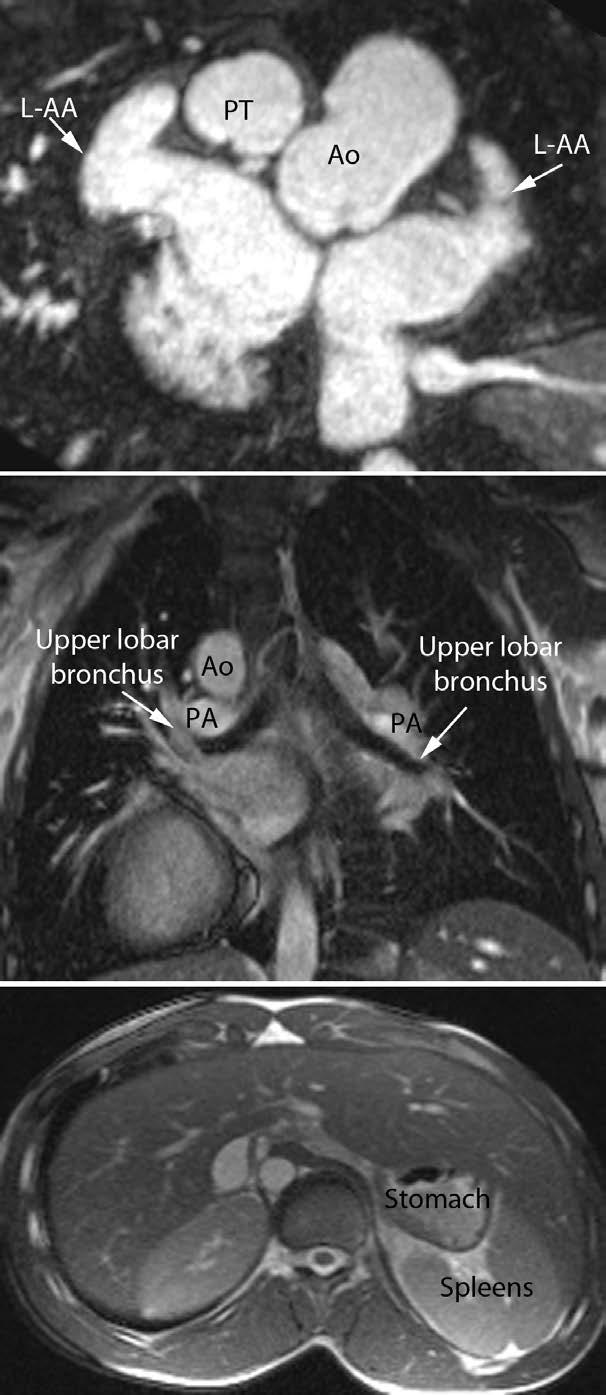 5 Yim et al Disharmonious Patterns of Heterotaxy and Isomerism Figure 3. Heterotaxy with classic left isomerism and polysplenia. Both side atrial appendages are long and narrow.