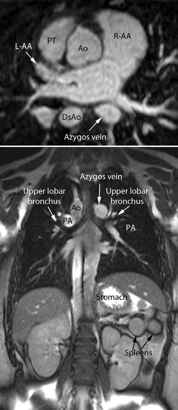The interrupted inferior vena cava connects to the dilated azygos vein.