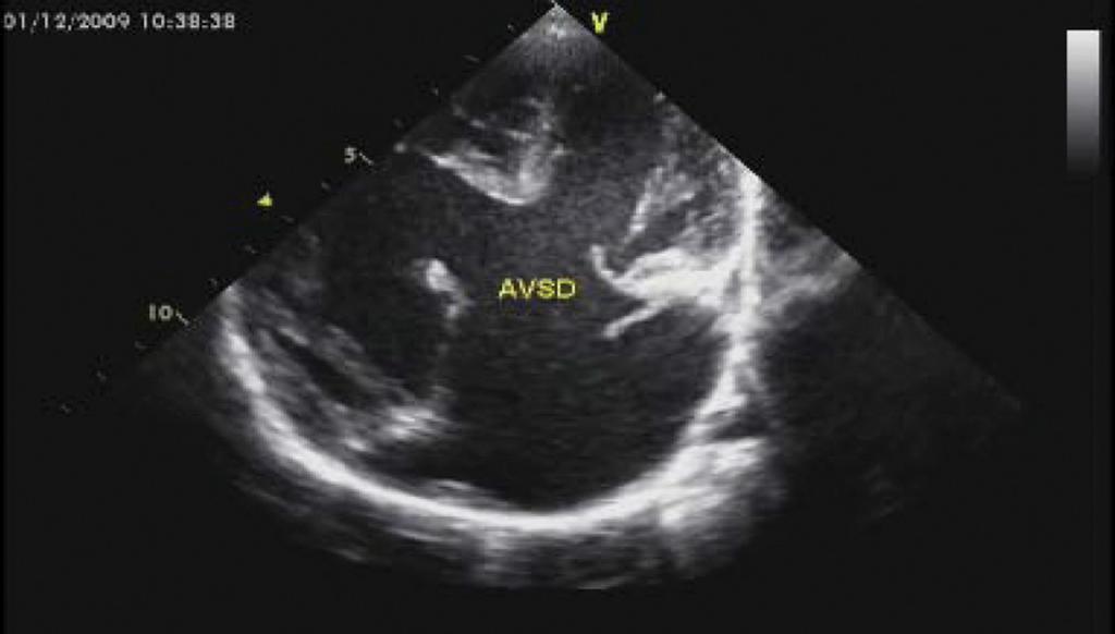 Fig. 7: 2D echocardiogram 4 chamber view demonstrating bilateral finger-like atrial appendages in left isomerism.