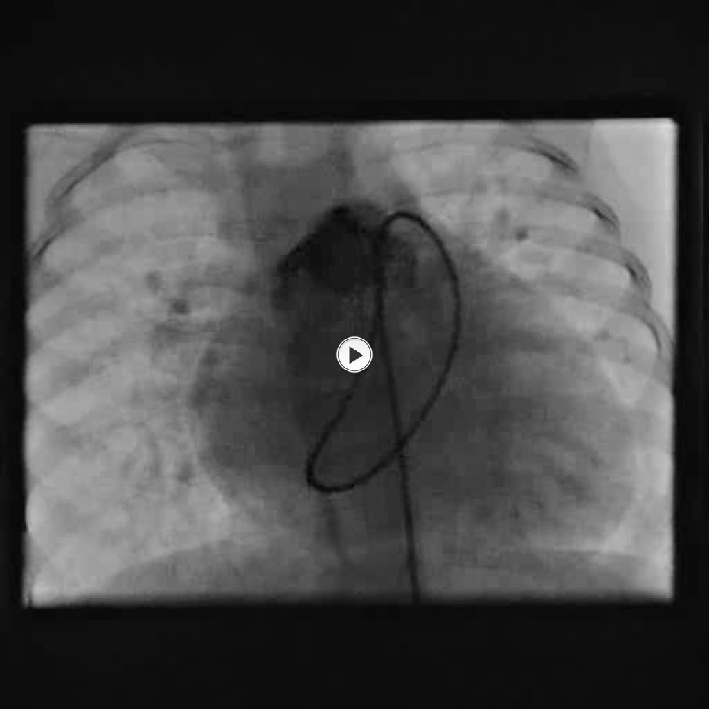Fig. 17: Cardiac catheterization caudal view demonstraing bilateral left pulmonary artery configuration.