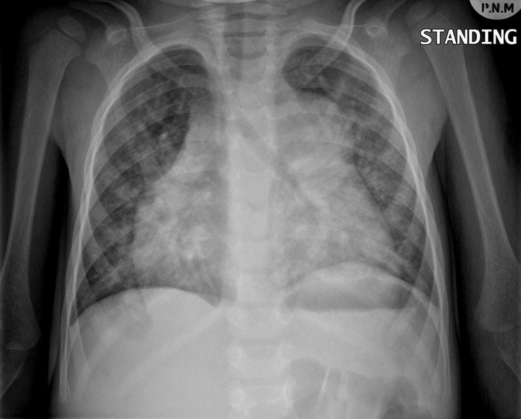 Fig. 3: Frontal chest radiograph demonstrating cardiomegaly with left-sided stomach bubble in left