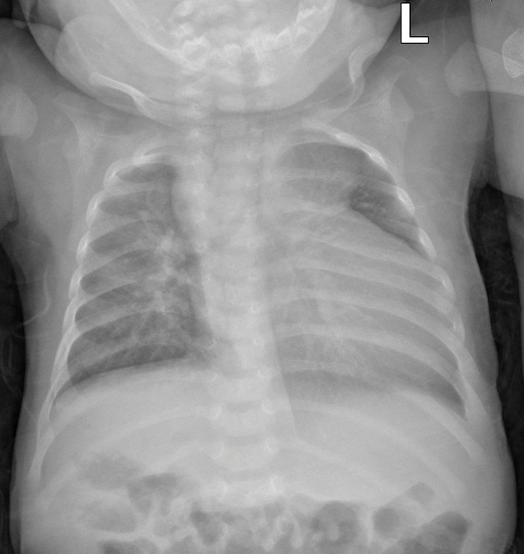 Fig. 4: Frontal chest radiograph demonstrating left cardiac apex and midline liver in left