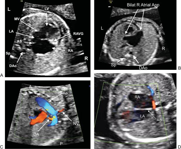 98 Right Atrial Isomerism with Tricuspid Atresia Solomon et al. Fig. 1 Prenatal (fetal) ultrasound images.