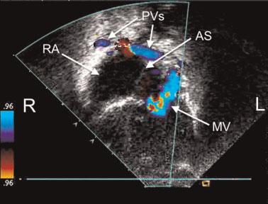 Arrows point to bilateral atrial appendages that appear morphologically right-sided.
