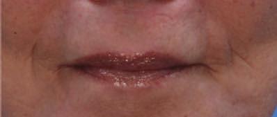 full-field Contour TRL Er:YAG perioral resurfacing, deep wrinkles may still be