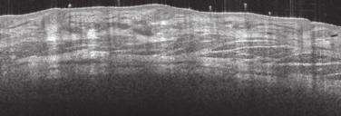 OCT imaging of orbicularis oculi muscle (arrow) enables precise measurement of
