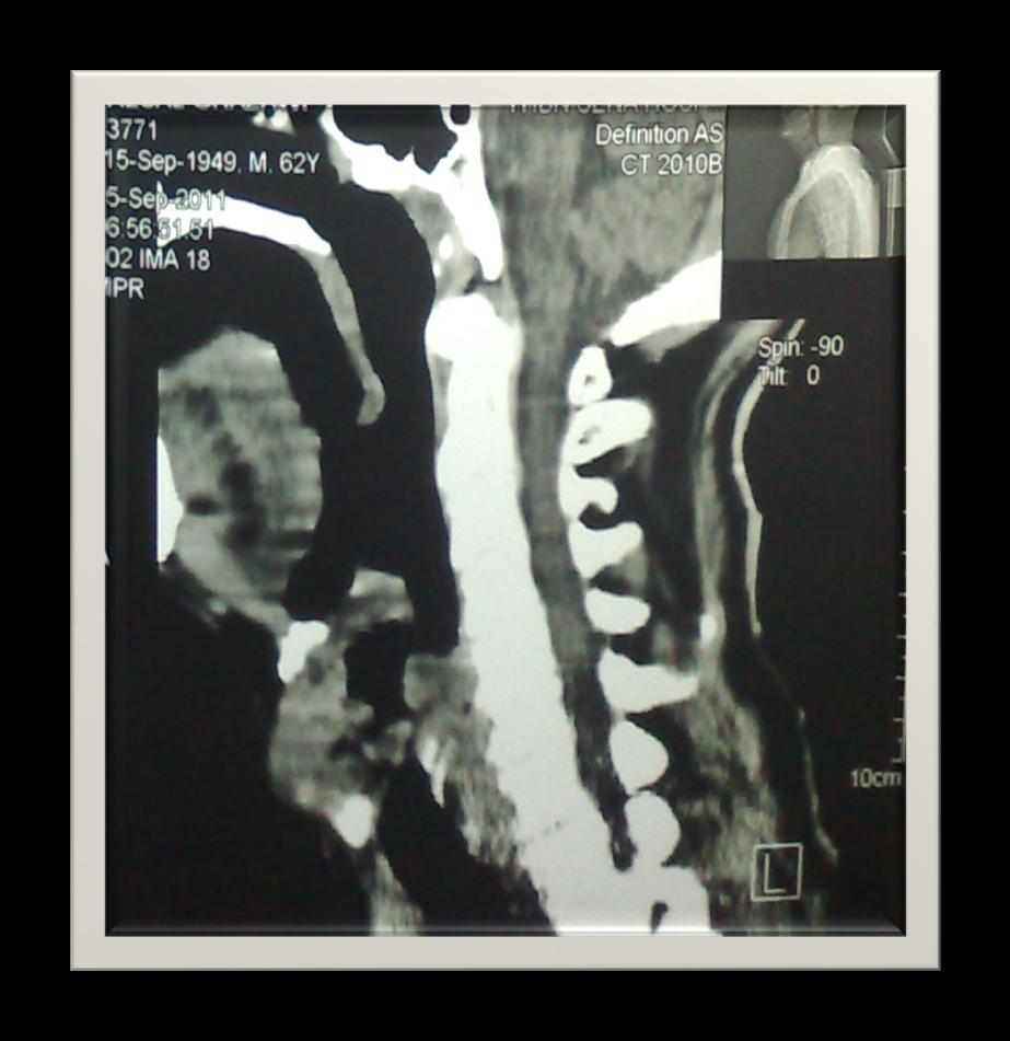 CT Scan of the neck : To assess