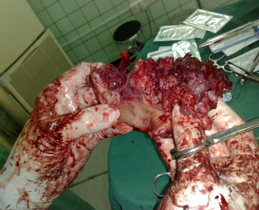 Total Laryngectomy with