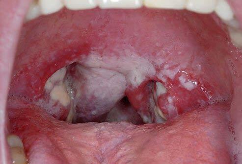 DDx: Sore Throat and Fever Common Causes: Viral