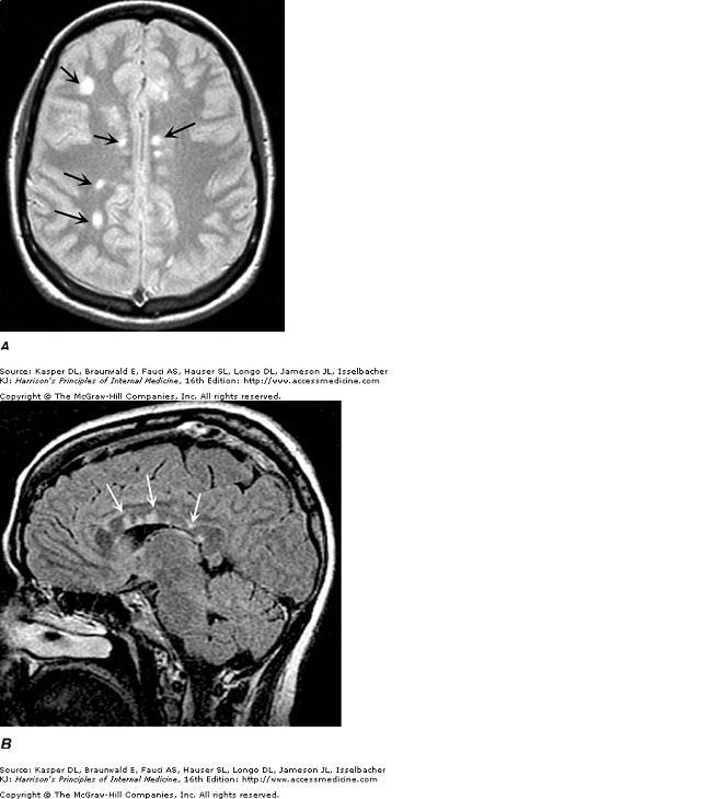 B. neurofibromatosis type 2 Neurofibromatosis, a common neurocutaneous disorder, includes numerous different forms.