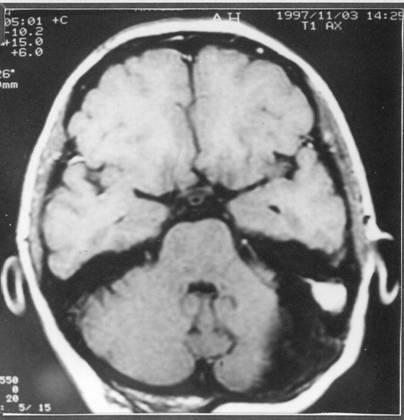 Gadolinium-enhanced T1-weighted axial magnetic resonance image reveals a large right-sided cerebellar tumor.