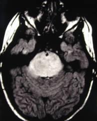 On CT, these tumors infiltrate and enlarge the brain stem and secondarily displace the fourth ventricle.