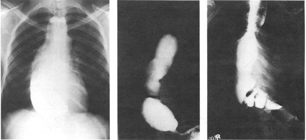 (C) Barium esophagogram made a year after repeat esophagornyotomy and Nissen fundoplication shows good results. A B Fig 3.